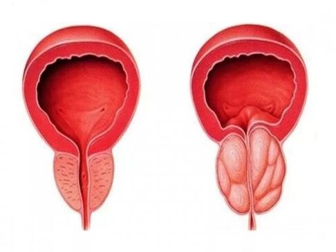 prostata sana e infiammata